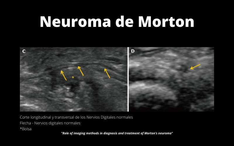 Neuroma Morton.png